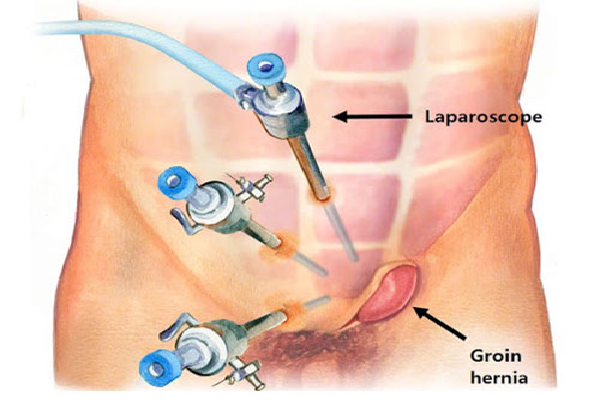 Hernia and Hydrocele