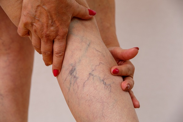 Varicose Vein